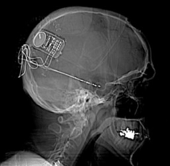 Imagen: El sistema implantado RNS (Fotografía cortesía del Centro Médico de la Universidad de Rochester).